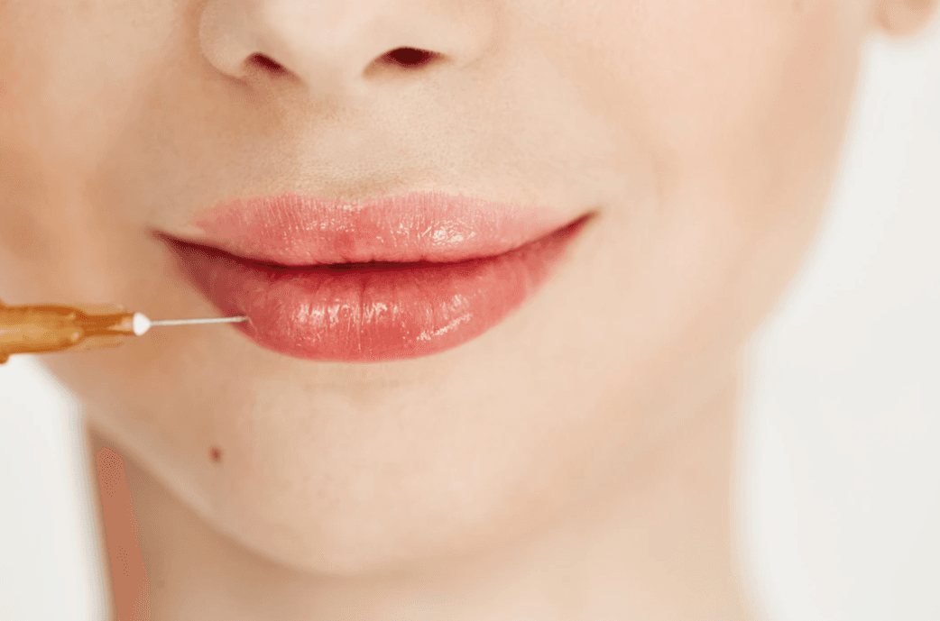 Augmentation des lèvres Ankara | Lèvres naturellement pulpeuses